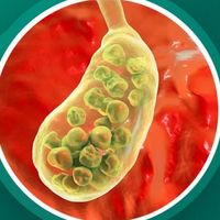 cholecystitis